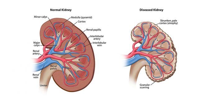 CLS suy thận cấp – NSAIDS và ACEI