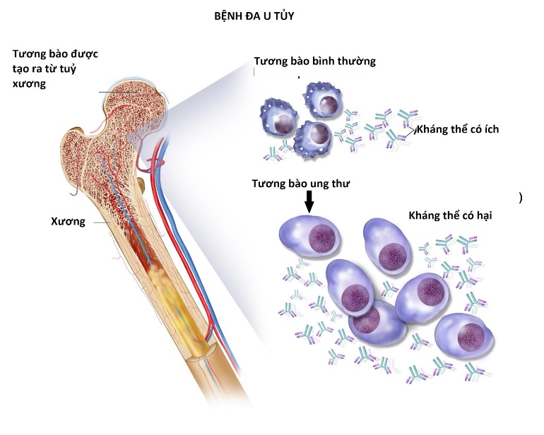 Hình ảnh đa u tủy xương